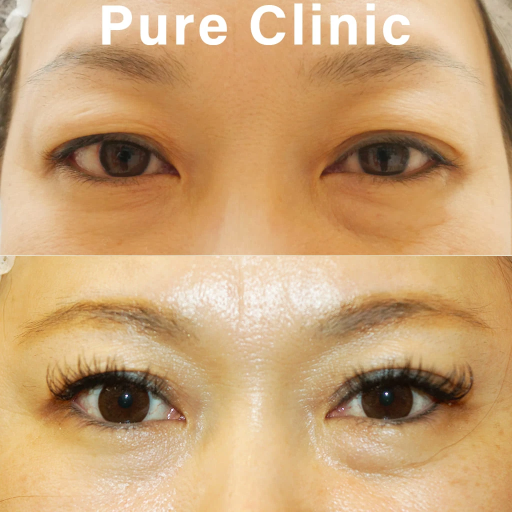 上眼瞼しわ取り術によるたるみ改善