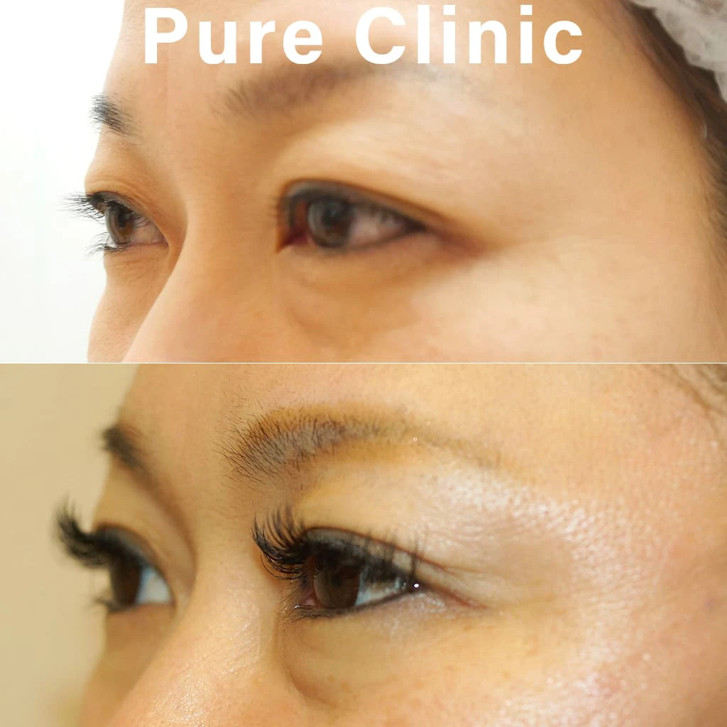 上眼瞼しわ取り術によるたるみ改善