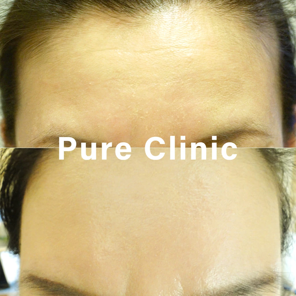 ボツリヌストキシン製剤