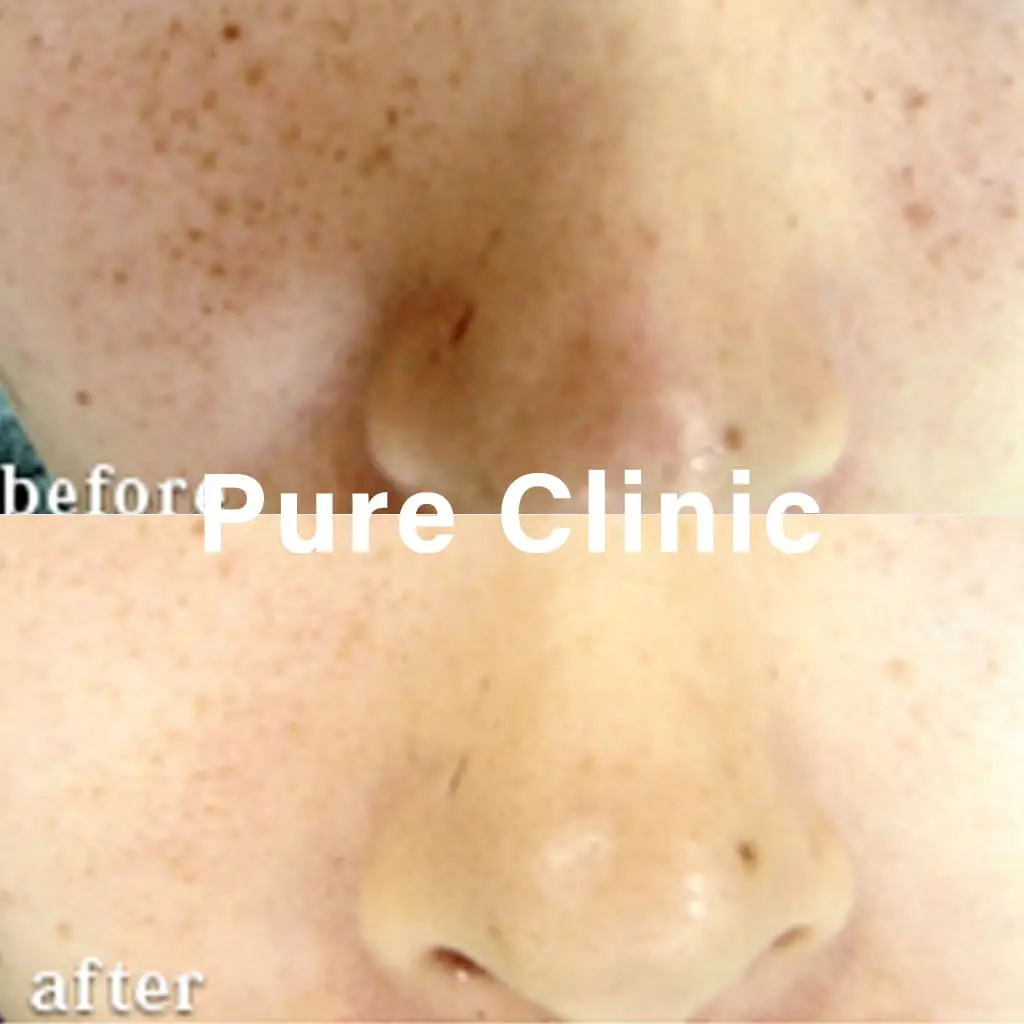 ライムライトによるそばかすの改善