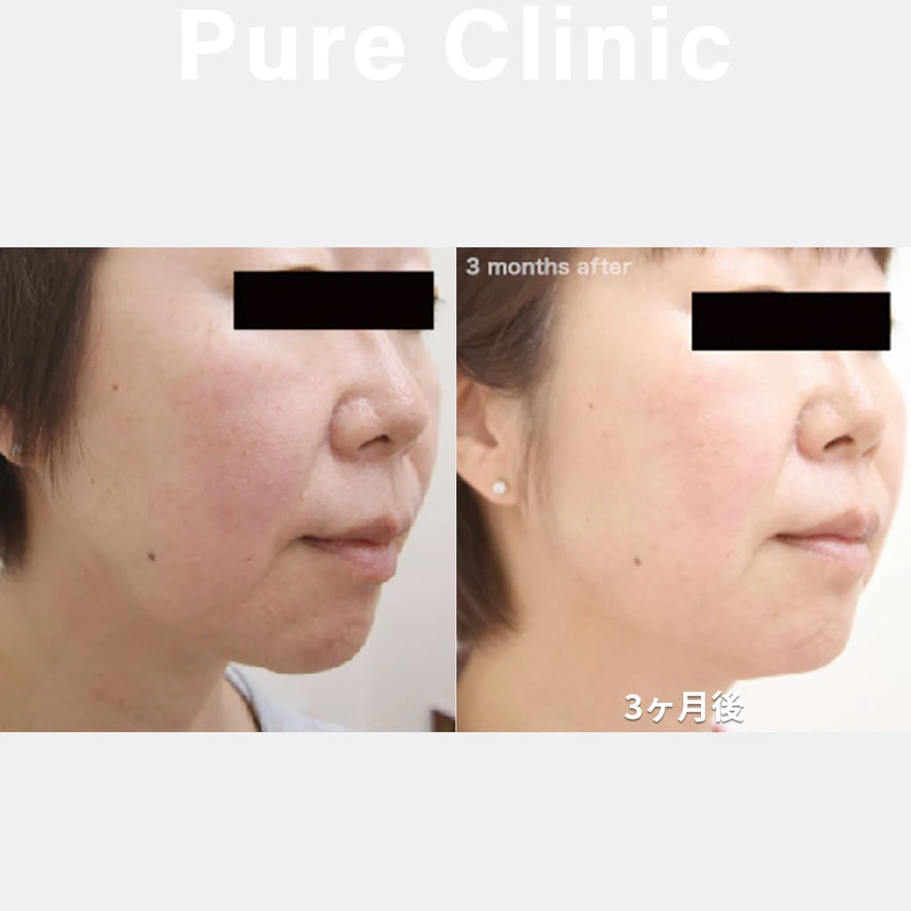 ウルトラセルＱ+によるたるみの改善