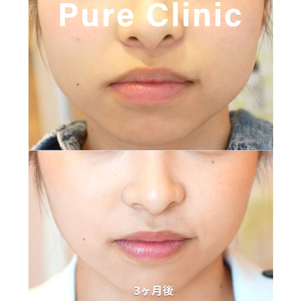 ボツリヌストキシン製剤によるエラの改善