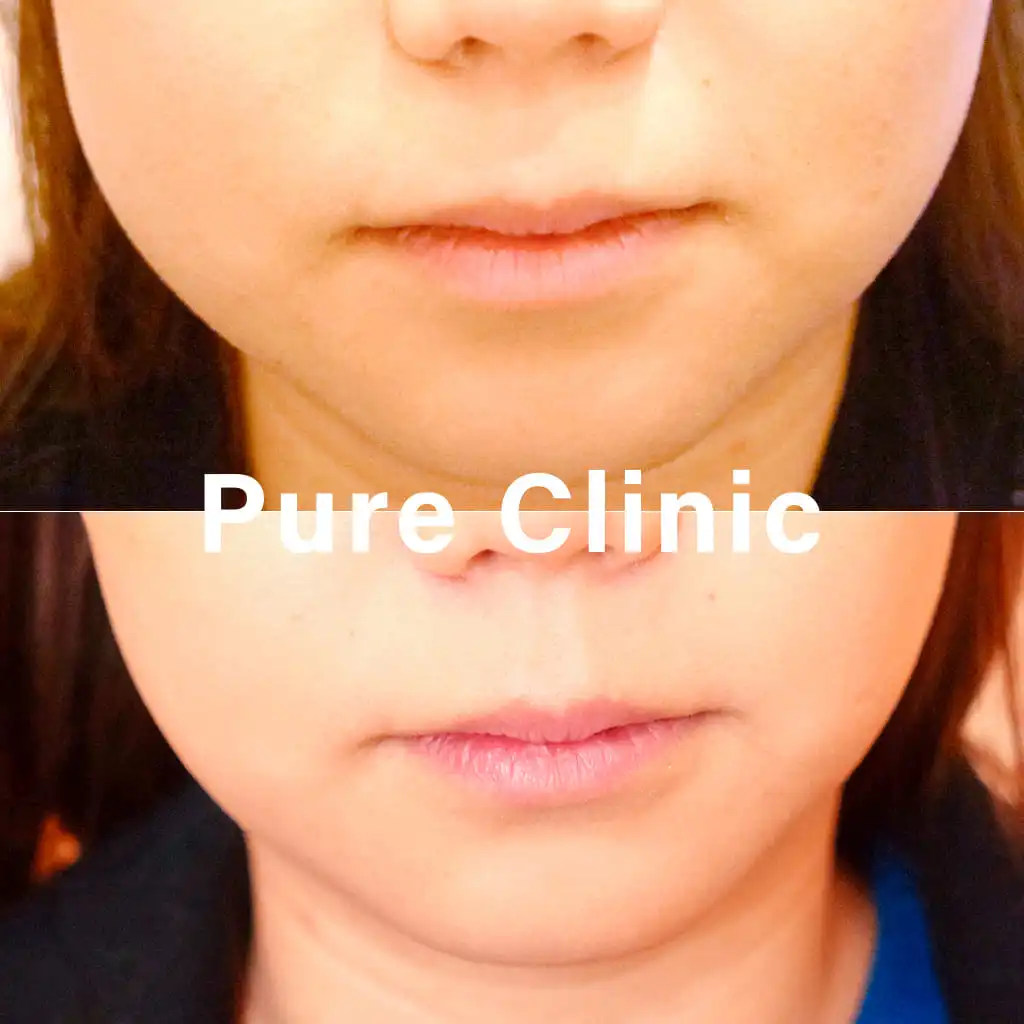 ボツリヌストキシン製剤によるエラの改善