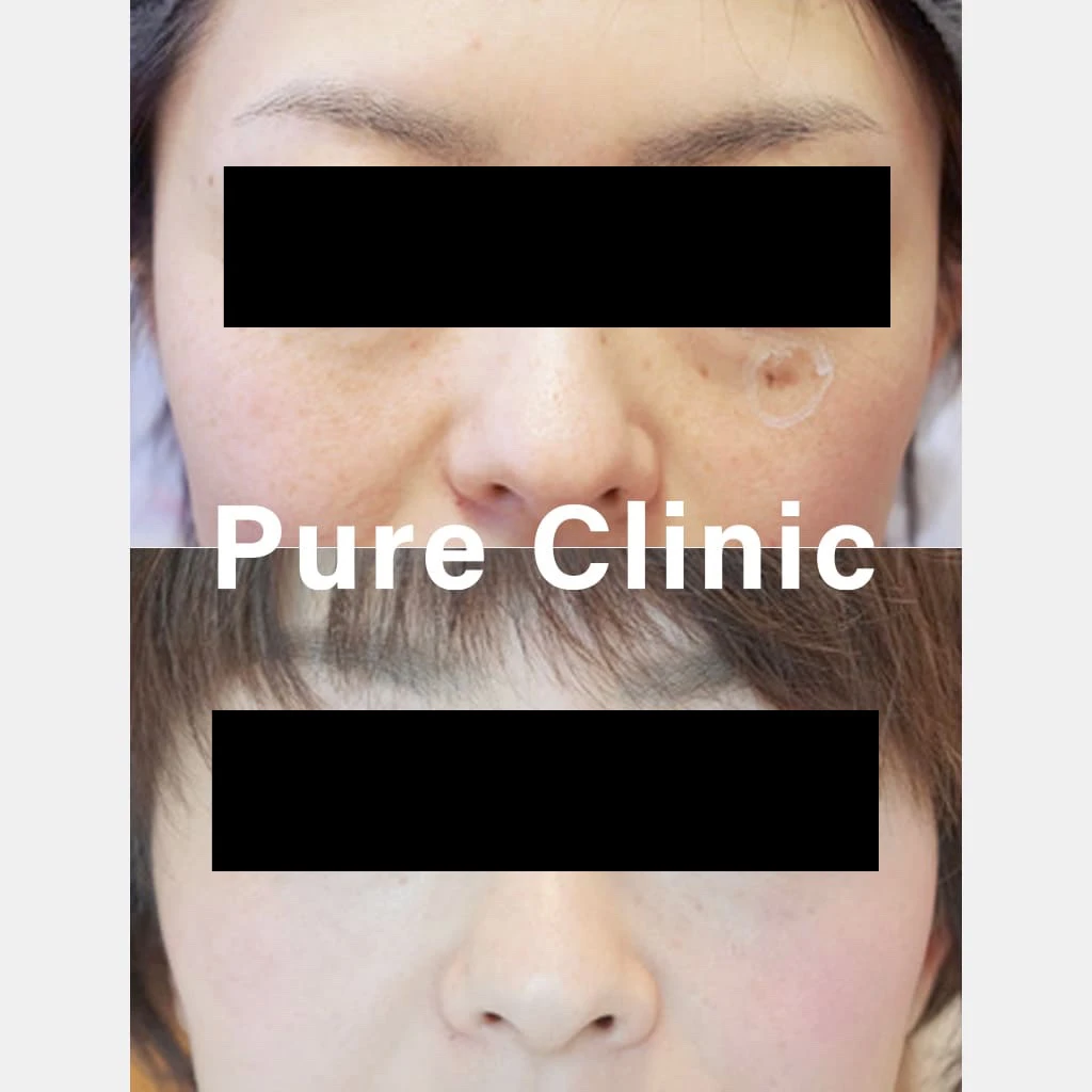 しみ取りレーザー