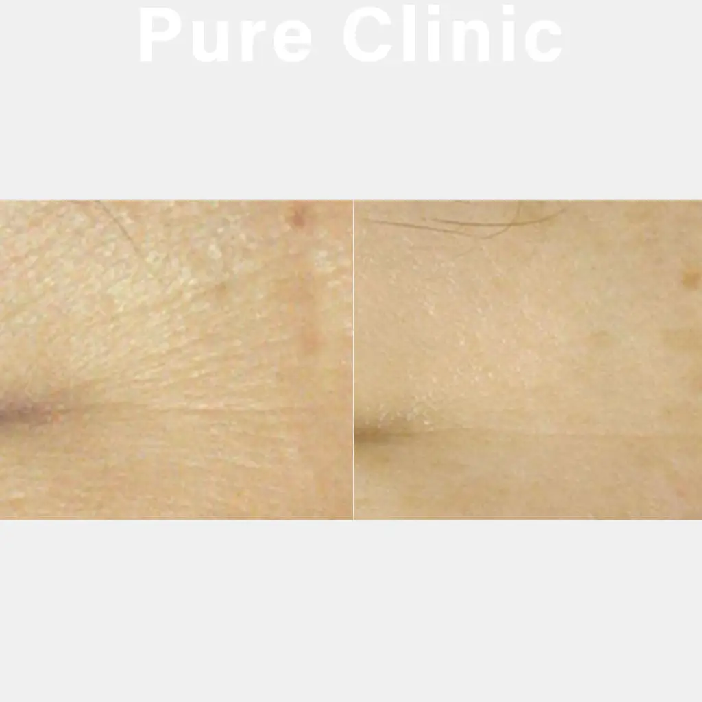 ダーマペン4によるしみ・小じわの改善