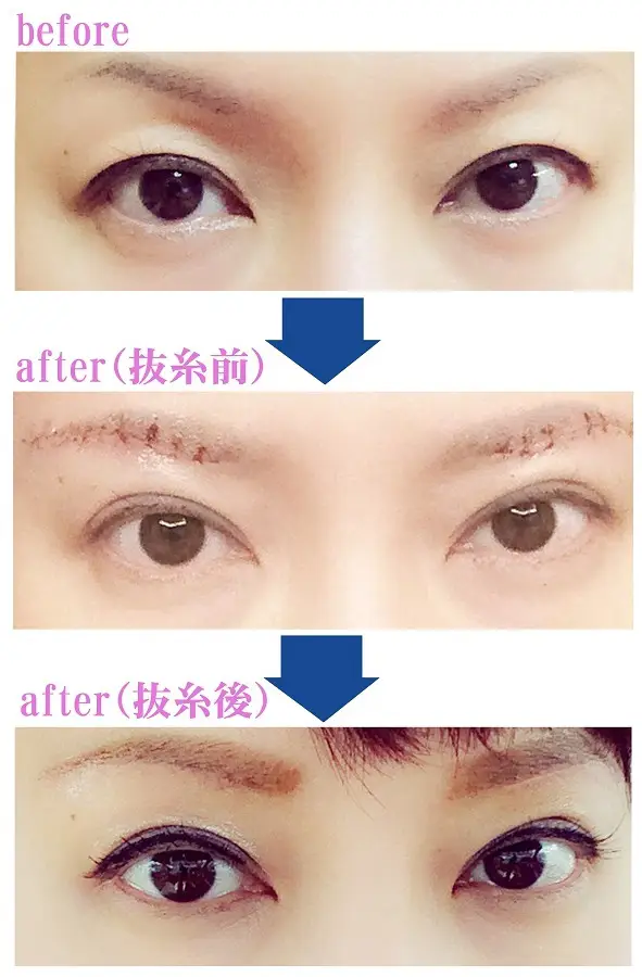 眉毛下リフト
