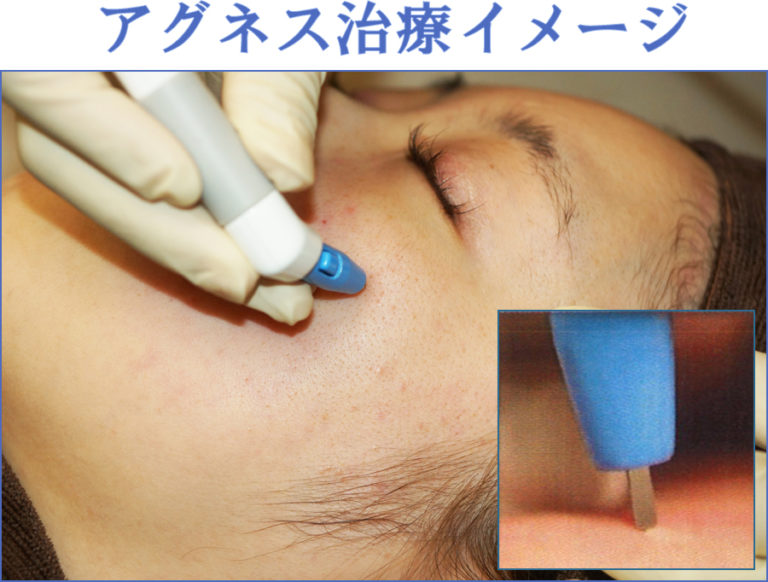 アグネス治療イメージ