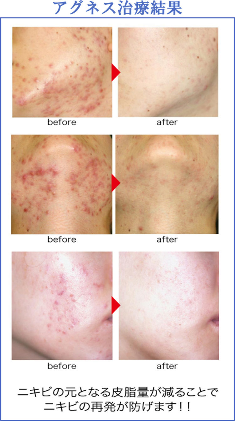 アグネス治療結果