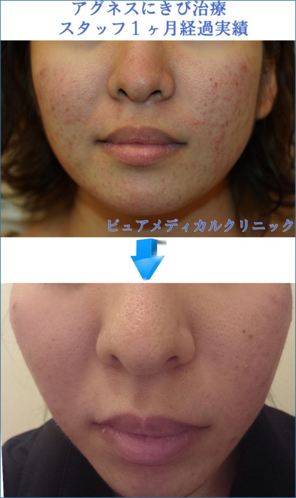 アグネス治療実績