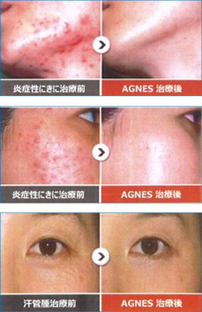 アグネス治療結果