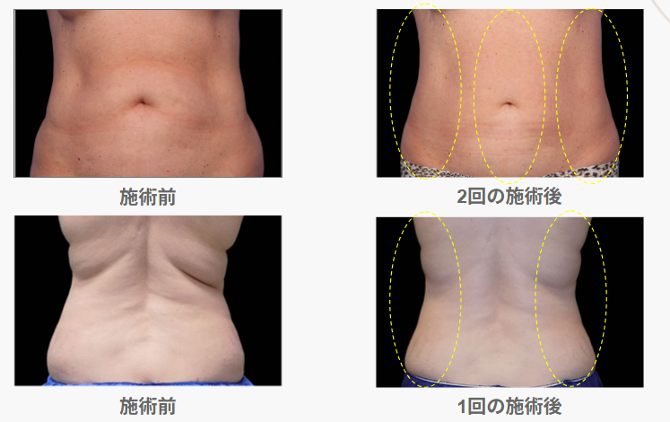 クールスカルプティング®エリート